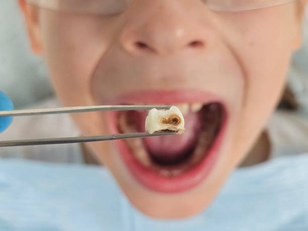 Best Emergency Dentist for Knocked-Out Tooth in Delafield, WI
